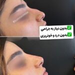 فیلربینی