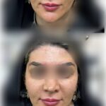 فیلر گونه