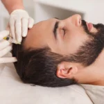 مزوتراپی چیست؟ بررسی کامل مزوتراپی صورت و مو، مزایا، عوارض و تعداد جلسات
